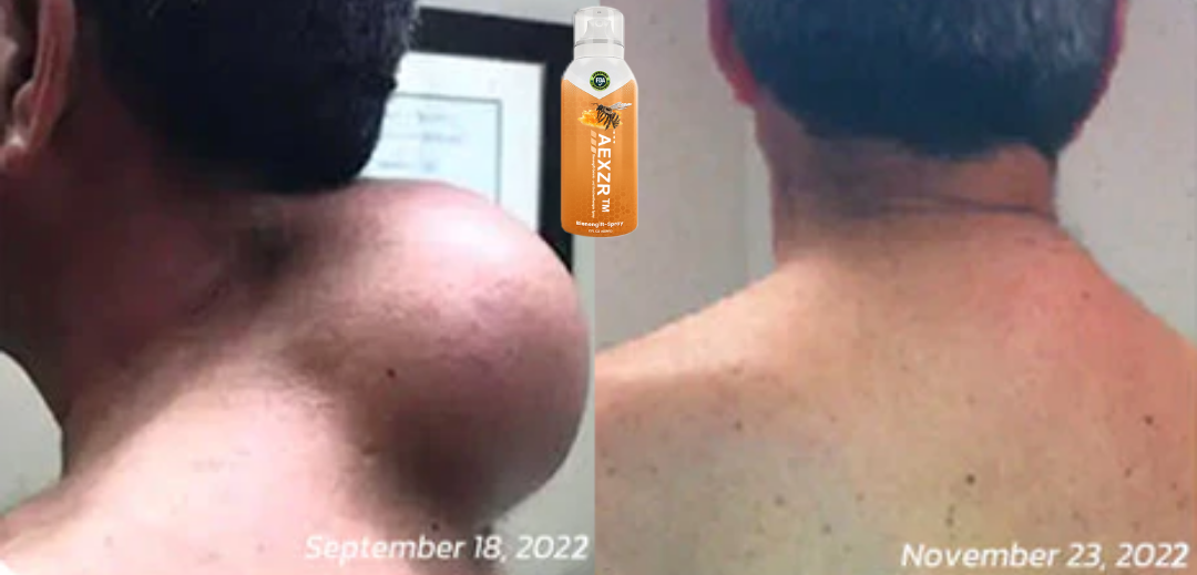 AEXZR™ Bienengift Gelenk und Knochentherapie Spray (Ganzkörper-Wiederherstellung)